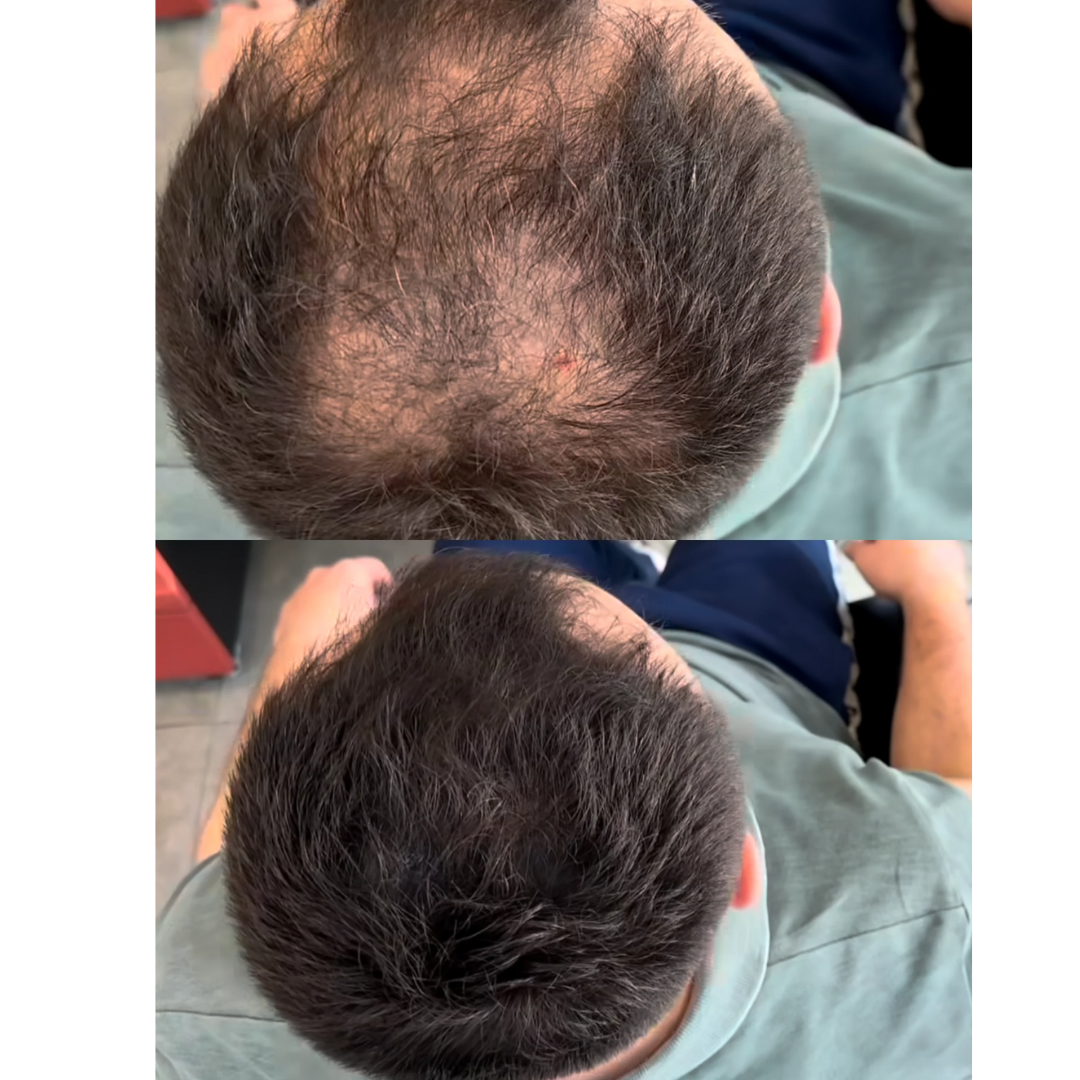 Scalp Concealer for Fuller, Natural-Looking Hair (BUY 1 GET 1 FREE)